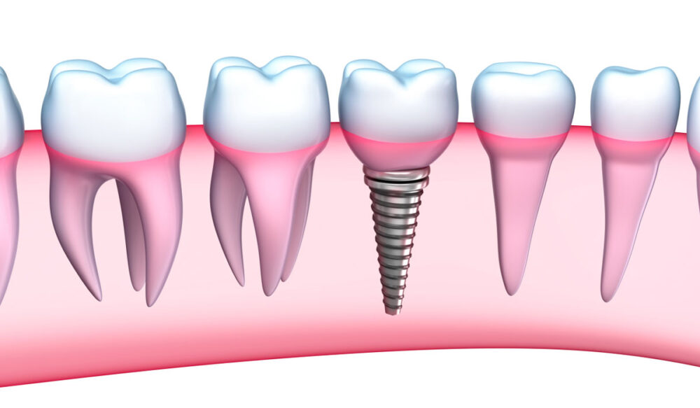 Μπορούν τα οδοντικά εμφυτεύματα να αποκτήσουν τερηδόνα;
