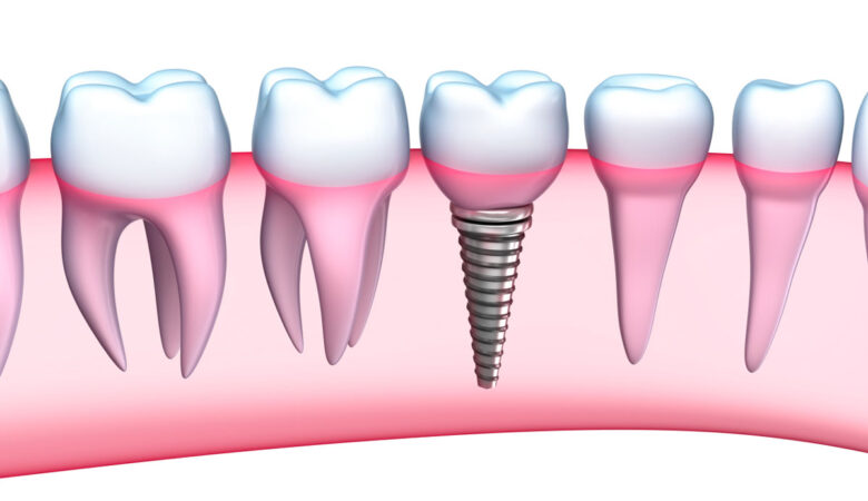 Μπορούν τα οδοντικά εμφυτεύματα να αποκτήσουν τερηδόνα;